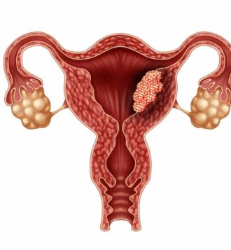 Fibroid Embolisation - Top Gynaecologists