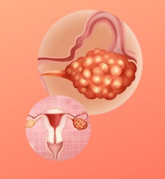 Ovarian Cyst Treatment - Top Gynaecologists UK