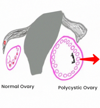 A diagram illustrating the differences between a healthy ovary and a polycystic ovary, accompanied by Metformin 500mg tablets on the right hand side of the image.