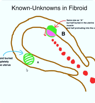 Fibroids treatment in London