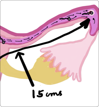 Adenomyosis treatment in London