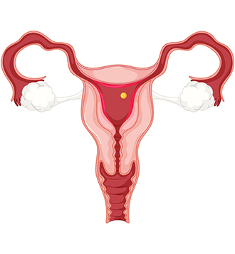 Endometrial Hyperplasia and its Treatments| Top Gynaecologists