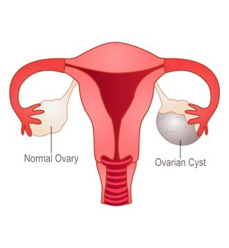 Ovarian Cysts Bleeding - Top Gynaecologists