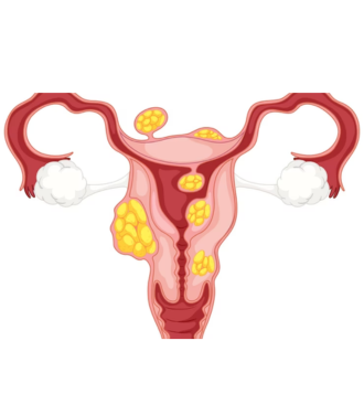 Ovarian Cysts Treatment Uncovered A Comprehensive Guide