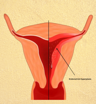 Endometrial Hyperplasia Treatment- Top Gynaecologists London