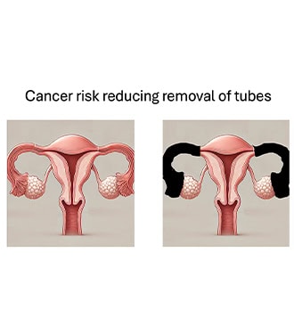 Ovarian Cancer Prevention